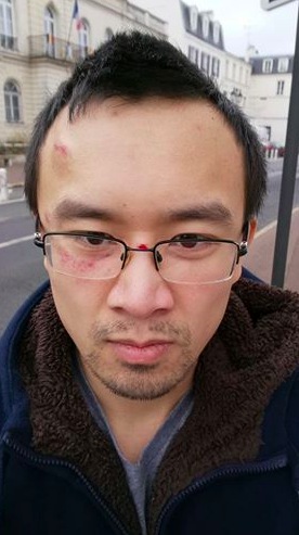 Albert Cheng après l'incident a été laissé avec le nez ensanglanté et une ecchymose sur le front.