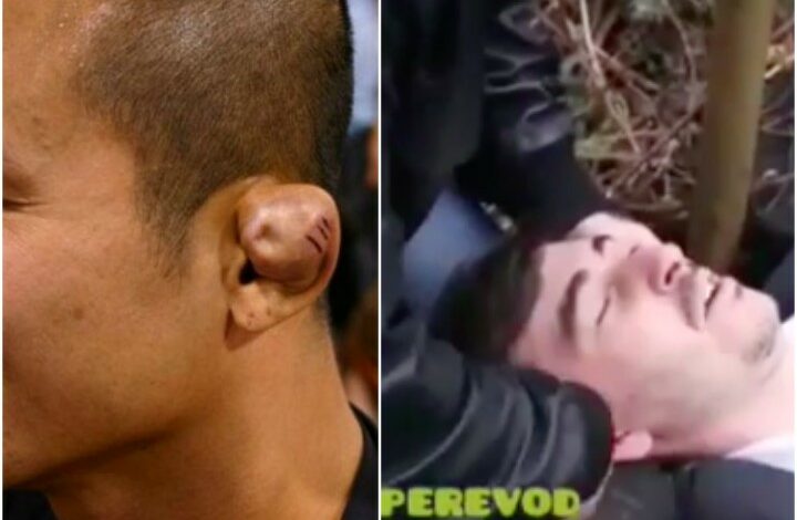 Madness: Grapplers Giving Themselves Cauliflower Ears To Look Tougher