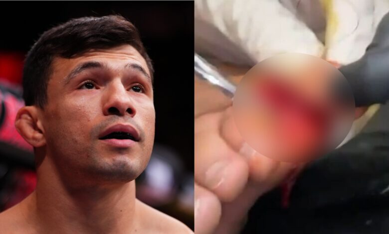 Alessandro Costa enters the Octagon for his fight against Alden Coria at Noche UFC, opposite a graphic, blurred image of Costa's toe injury