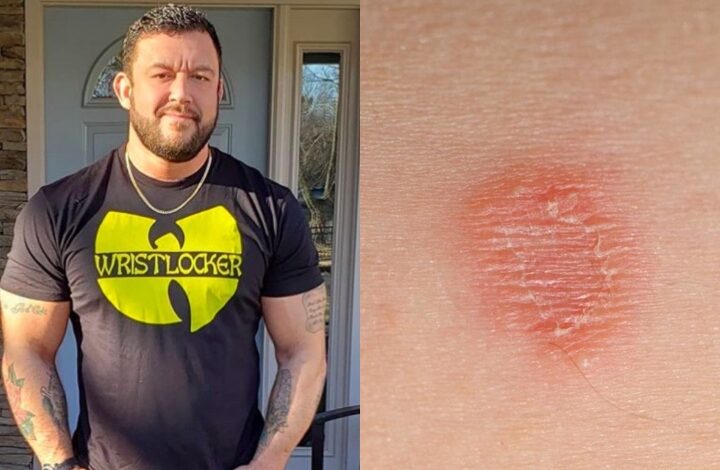 Tom DeBlass Calls Out Training With Skin Infections: “A Selfish Move”